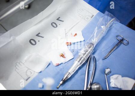 Extracted wisdom teeth on a medical tray table with dental tools and equipment. Wisdom tooth extraction surgery. Stock Photo