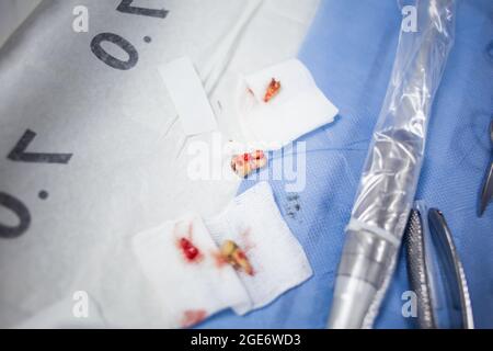 Extracted wisdom teeth on a medical tray table with dental tools and equipment. Wisdom tooth extraction surgery. Stock Photo