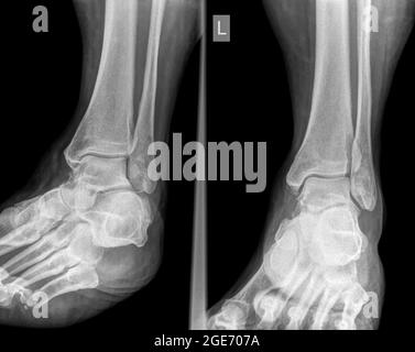 Fracture of the distal tibia and fibula. X-ray of a 57 year old male ...