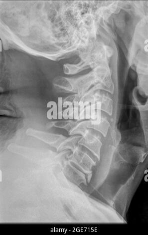 Cervical spine x-ray with a fractured Dens. A 50 year old male patient side View Stock Photo