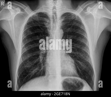 Normal Healthy Chest x-ray of a 36 year old male. front view Stock Photo