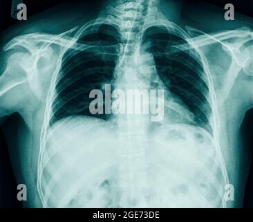 fracture of the number 10 rib can be seen in a Chest x-ray of a 36 year old male. front view Stock Photo