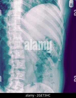 fracture of the number 10 rib can be seen in a Chest x-ray of a 36 year old male. front view Stock Photo