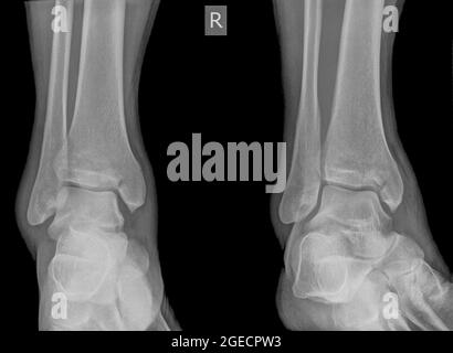 X-ray of an ankle 50 year old male with a fractured tibia. Front view Stock Photo