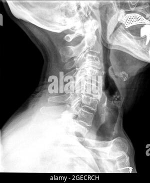 healthy cervical spine x ray