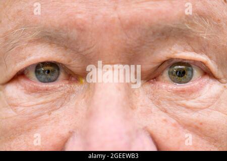 Extreme close up of an elderly man suffering from anisocoria showing unequal dilation of his pupils caused by an optical disease or brain tumour Stock Photo