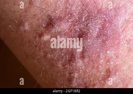 Lichen planus on leg skin close-up. Dermatological disease in form of red spots, rashes and itchy skin surface. Stock Photo