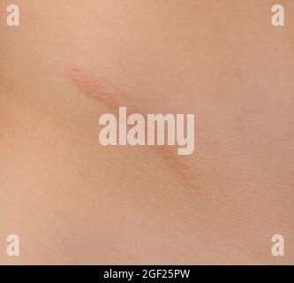 Healed scar after Appendicitis surgery. Stock Photo