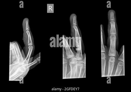 3 views of the forth finger right hand after suffering Contusion with ...