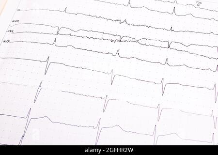 Electroencephalogram graph on a white paper close up Stock Photo