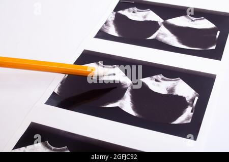 Image of an ultrasound scan of the prostate Stock Photo