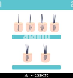 Hair micrograft classification set for hair transplantation surgery, conceptual illustration. Stock Photo