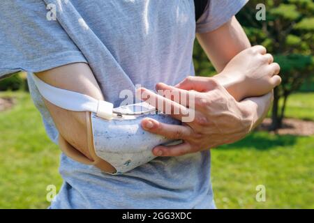 Young man with disability puts on a prosthesis outdoors Stock Photo