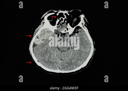 A CT brain scan of a patient with epidural hematoma at right temporal convexity with mass effect. Tension pneumocephalus. Multiple facial, sinuses, an Stock Photo