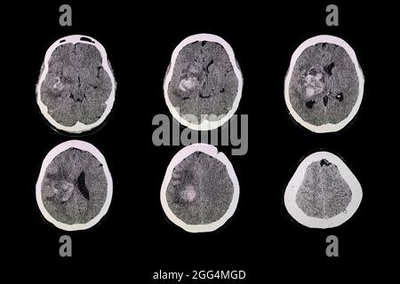 CT brain scan of the patient with hemorrhage and hematoma at right basal ganglia. Stock Photo