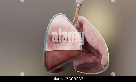 3d Illustration of Hemopneumothorax, Normal lung versus collapsed, symptoms of Hemopneumothorax, pleural effusion, empyema, complications Stock Photo