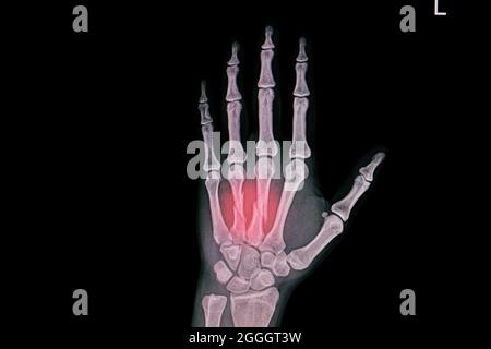 Hand xray showing closed fracture third and forth metacarpal bones. Stock Photo