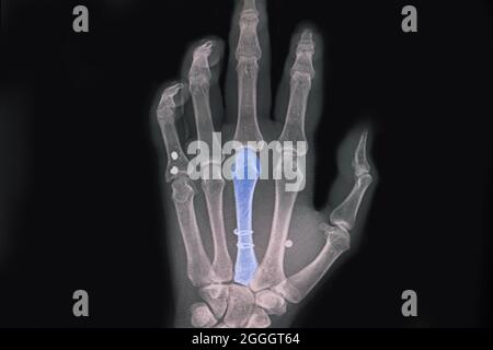 Hand xray showing spiral fractured third metacarpal bone after surgical fixation with two circular wires. Stock Photo