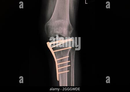 X -ray film of a knee of a patient with fractured proximal tibia after plate and screws fixation. Stock Photo