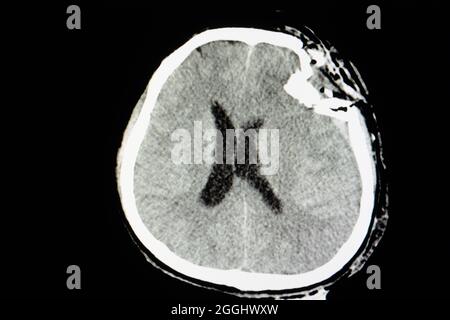 CT skull film of a patient with traumatic brain injury showing compression fracture of left temperoparietal bone. Stock Photo