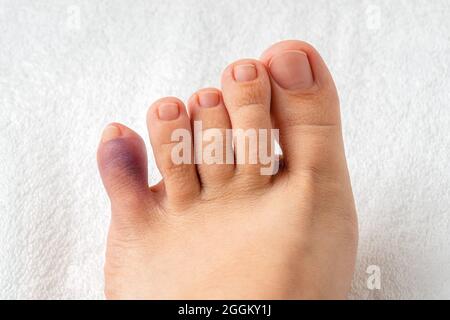 Purple bruise on the little toe of female person foot. Injury of foot little finger after home accident. Broken pinky toe, phalange fracture. Top view Stock Photo