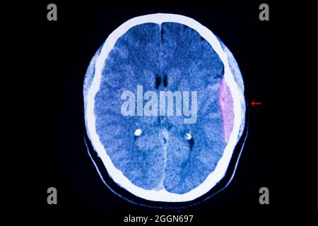 CT scan of the brain of a traffic accident patient showing large epidural hemorrhage on his left cerebral hemisphere with some degree of brain edema Stock Photo