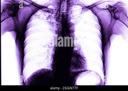 Chest xray film of a patient having tubercolosis in his right upper lung. Stock Photo