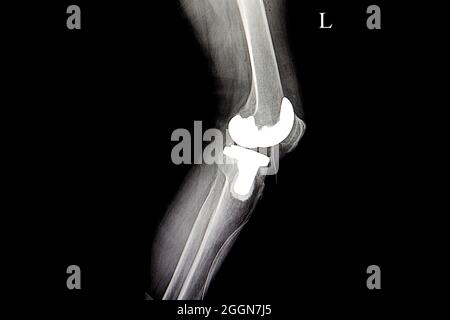 x ray film of a patient with total knee replacement Stock Photo