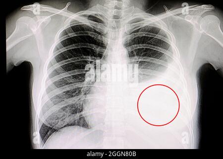 Pleural effusion, X-ray Stock Photo - Alamy