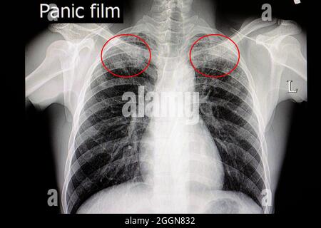 Xray film of a pateint with pulmonary tuberculosis Stock Photo