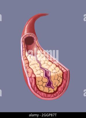 A clogged artery or Atherosclerosis (arteriosclerotic vascular disease - ASVD) is when the artery walls thicken due to the buildup of cholesterol. Stock Photo