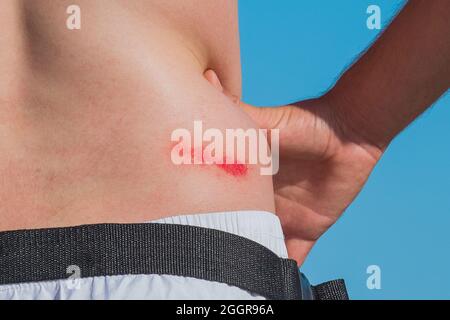 Man's hand on the belt next to a fresh wound abrasion injury with blood on his side, close-up. Stock Photo