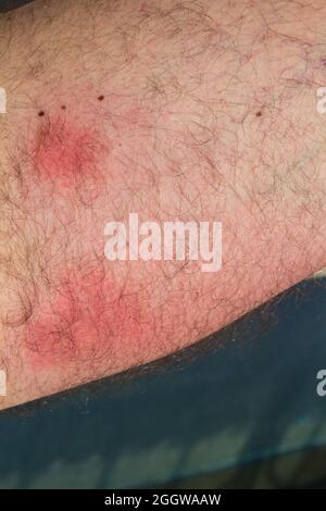 Wasp stings on skin after two day, red inflammation marks caused by wasp bite Stock Photo