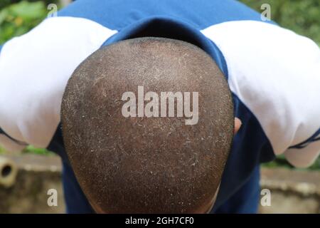 Man with a bald head with visible dandruff, scales on head, dryness problems of the scalp Stock Photo
