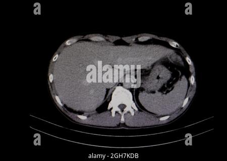 Diagnostic CT scan of human liver. Stock Photo