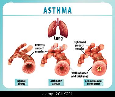 Asthma diagram with normal airway and asthmatic airway illustration ...