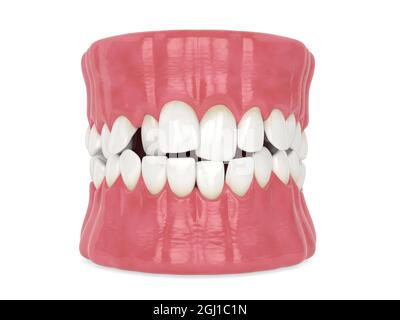 3d render of jaw with abnormal teeth position. Orthodontic treatment ...