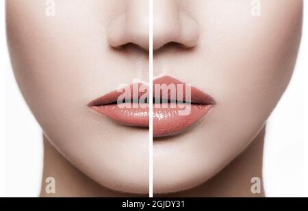 Female lips before and after augmentation procedure. Beauty concept Stock  Photo - Alamy