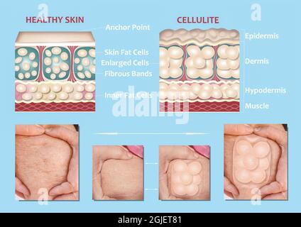 Forming of underskin cellulite illustration. Structure of normal healthy and cellulite skin. Comparison Stock Photo