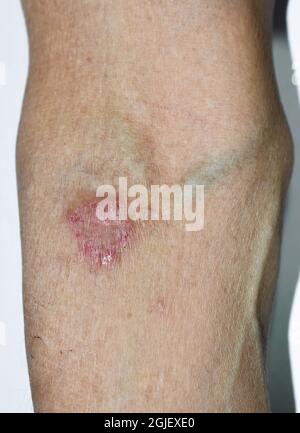 Tinea corporis or ringworm. Itching skin lesions on upper limb of Asian elderly woman. Stock Photo