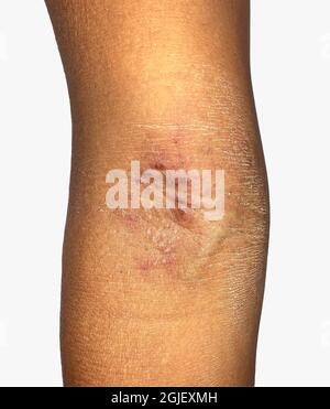 Itching skin lesions on upper limb of Asian child. Stock Photo
