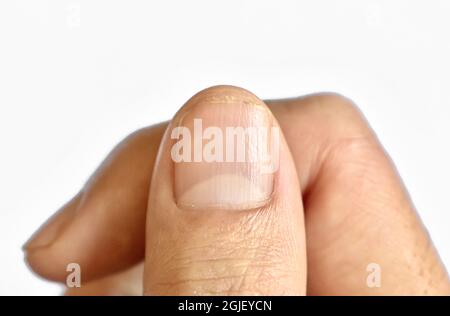 Muehrcke's nails - Wikipedia