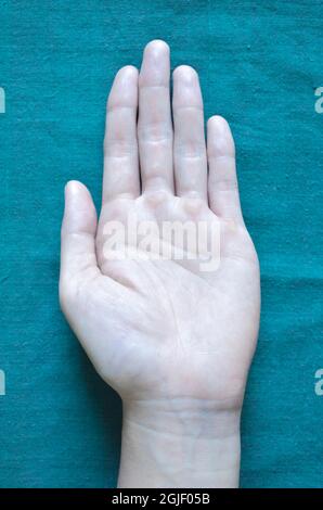 Pale palmar surface of hand. Anaemic hand of Asian, Chinese man. Stock Photo