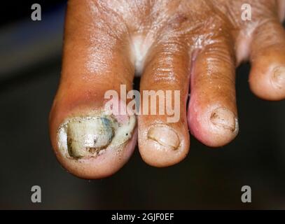 Fungal infection called tinea pedis and paronychia at toes of