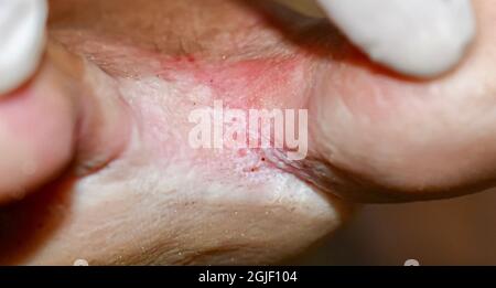 Fungal infection called tinea pedis at foot of Asian woman. It is itching lesion. Closeup view. Stock Photo