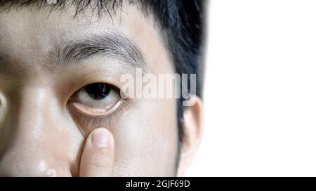 Pale skin of Asian man. Sign of anemia. Pallor at eyelid. Isolated on white. Stock Photo