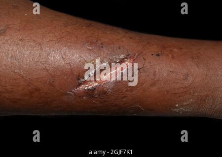 Poor wound healing or secondary wound healing with large wound gapping ...