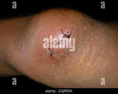 Stitched lacerated wound at knee area of Southeast Asian man. Isolated on black. Stock Photo