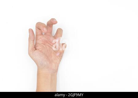 Hand muscle spasm in Asian young man. Unilateral hand deformity. Abnormal fingers flexion. Isolated on white background. Text space present. Stock Photo