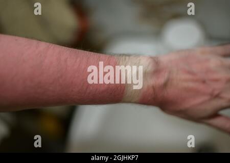 Sunburn on human hand. Selective focus with shallow depth of field. Stock Photo